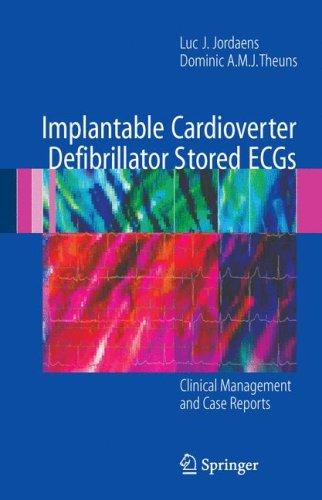 Cover for Implantable Cardioverter Defibrillator Stored ECGs